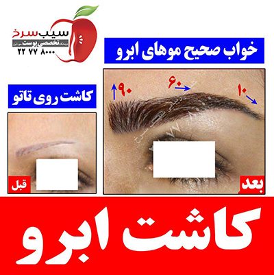 کاشت ابرو با موهای طبیعی