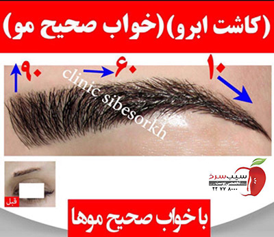 کاشت ابرو با موهای طبیعی