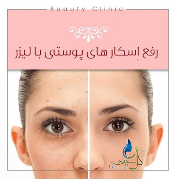 لیزر الکساندرایت کندلا، سیستمی فراتر از یک ماشین