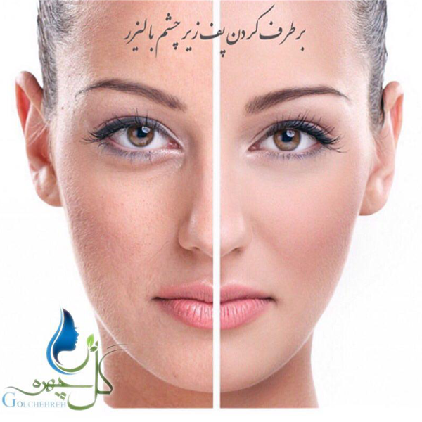 لیزر الکساندرایت کندلا، سیستمی فراتر از یک ماشین