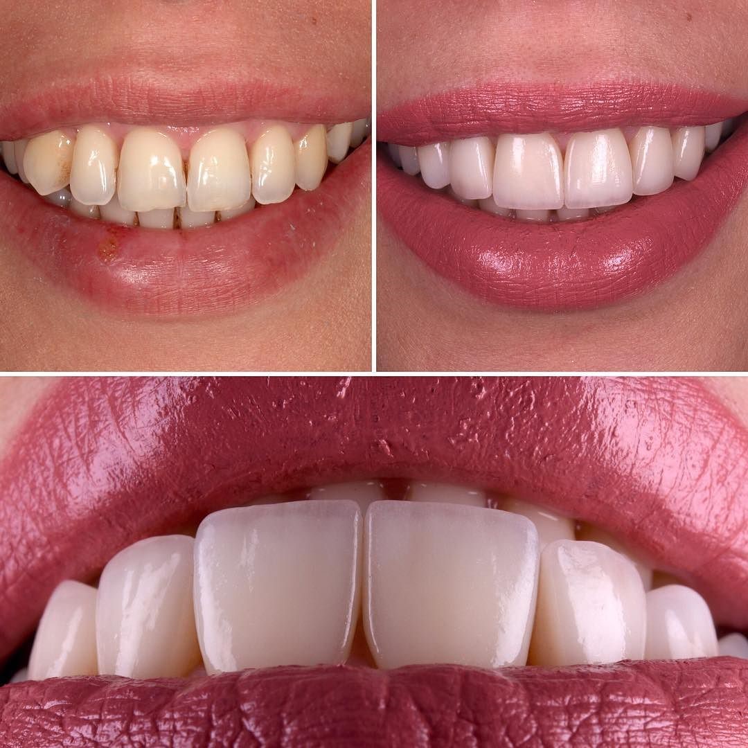 ایمپلنت بدون درد و استرس به روش دیجیتال بدون جراحی ایمپلنت بدون درد و استرس به روش دیجیتال بدون جراحی