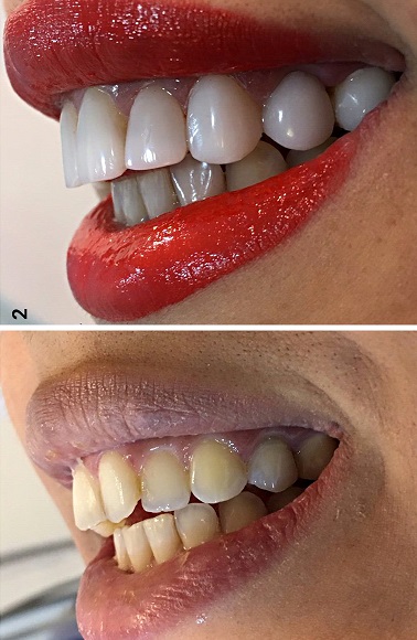 ایمپلنت بدون درد و استرس به روش دیجیتال بدون جراحی ایمپلنت بدون درد و استرس به روش دیجیتال بدون جراحی