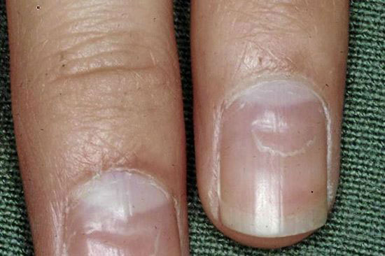 شکل و رنگ ناخن چه اطلاعاتی را در مورد سلامتی شما فاش خواهند کرد؟ شکل و رنگ ناخن چه اطلاعاتی را در مورد سلامتی شما فاش خواهند کرد؟