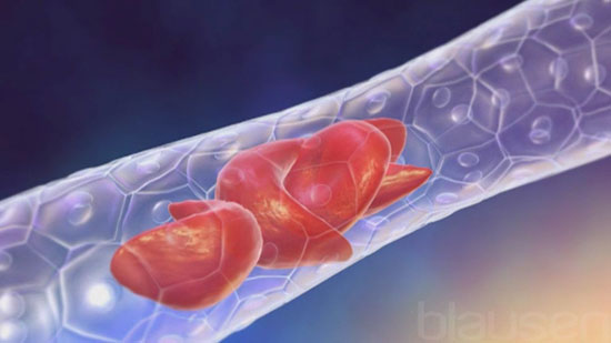 بیماریهای خون ؛ اختلال گلبولهای سفید و قرمز، پلاسما و پلاکت بیماریهای خون ؛ اختلال گلبولهای سفید و قرمز، پلاسما و پلاکت