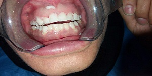 اصلاح طرح لبخند