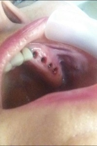 اصلاح طرح لبخند