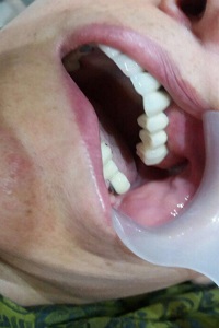 اصلاح طرح لبخند