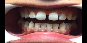 اصلاح طرح لبخند