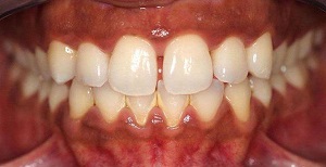 اصلاح طرح لبخند