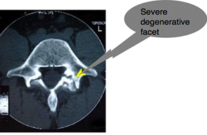 جراحی بسته دیسک کمر و گردن با لیزر