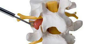 جراحی بسته دیسک کمر و گردن با لیزر