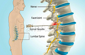 جراحی بسته دیسک کمر و گردن با لیزر
