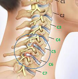 جراحی بسته دیسک کمر و گردن با لیزر