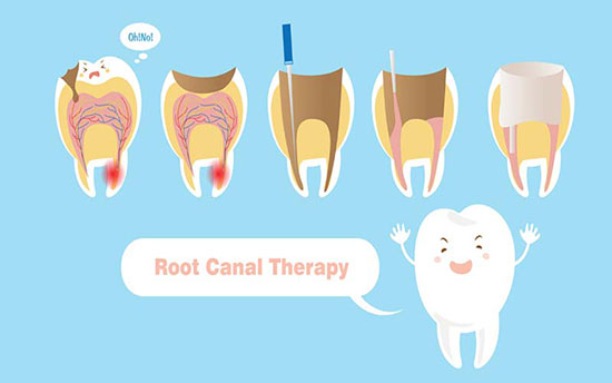 پاسخ به ۷ سوال رایج درباره عصب کشی دندان