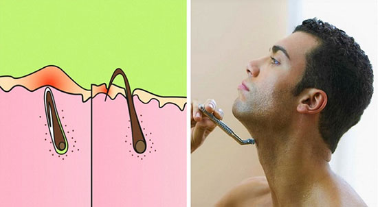 مو‌های زیر پوستی چرا به وجود می‌آیند؟