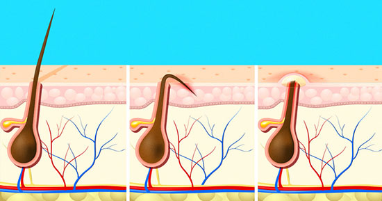 مو‌های زیر پوستی چرا به وجود می‌آیند؟