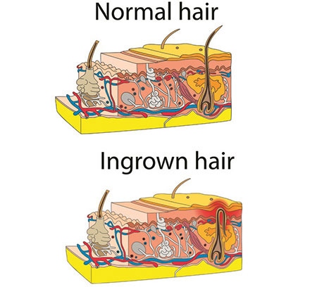 مو‌های زیر پوستی چرا به وجود می‌آیند؟