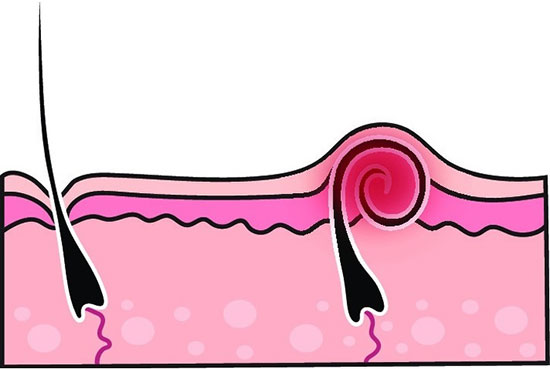 مو‌های زیر پوستی چرا به وجود می‌آیند؟