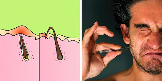 مو‌های زیر پوستی چرا به وجود می‌آیند؟