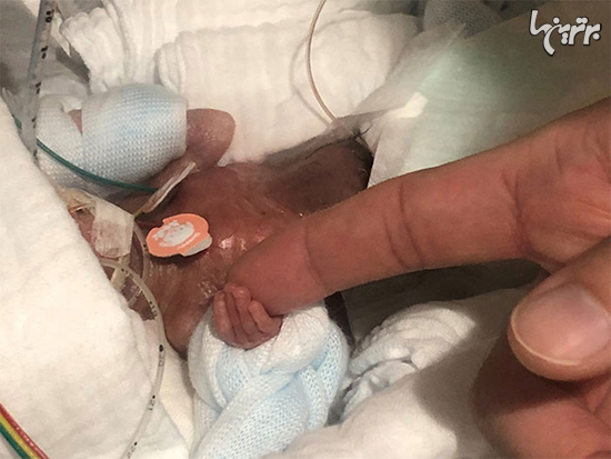 کوچکترین نوزاد نارس جهان بالاخره از بیمارستان مرخص شد