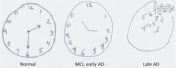 اهمیت ترسیم ساعت در تشخیص آلزایمر