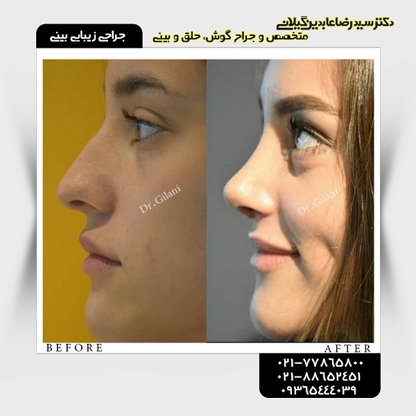 جراحی زیبایی بینی؛ قیمت سال ۹۸ و جدیدترین انواع آن