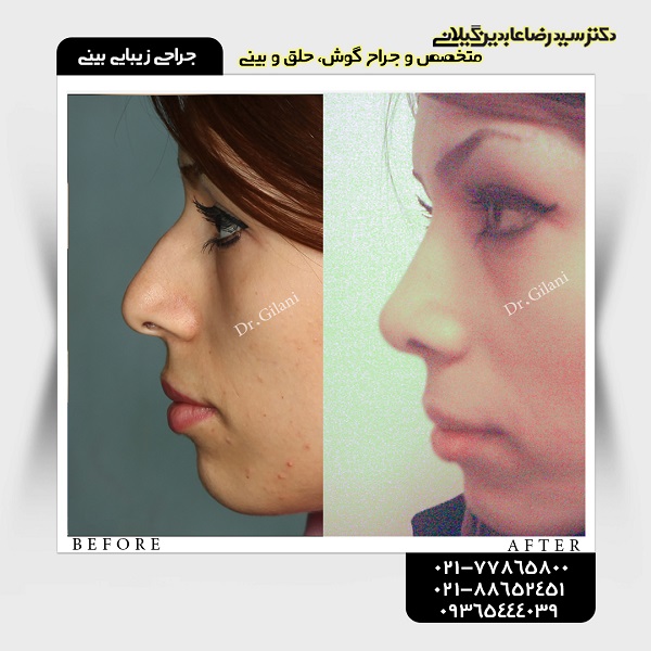 جراحی زیبایی بینی؛ قیمت سال ۹۸ و جدیدترین انواع آن