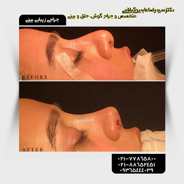 جراحی زیبایی بینی؛ قیمت سال ۹۸ و جدیدترین انواع آن