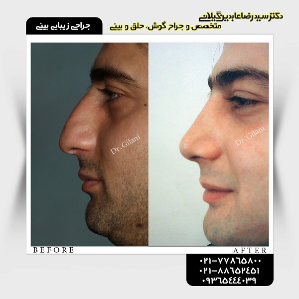 جراحی زیبایی بینی؛ قیمت سال ۹۸ و جدیدترین انواع آن