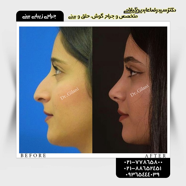 جراحی زیبایی بینی؛ قیمت سال ۹۸ و جدیدترین انواع آن