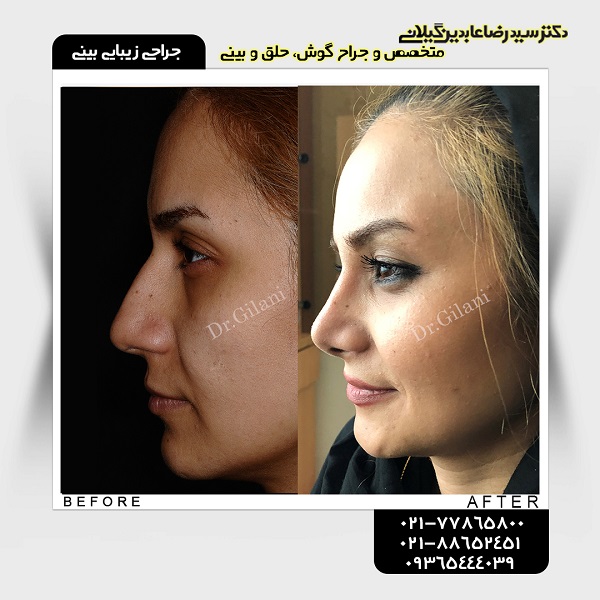جراحی زیبایی بینی؛ قیمت سال ۹۸ و جدیدترین انواع آن