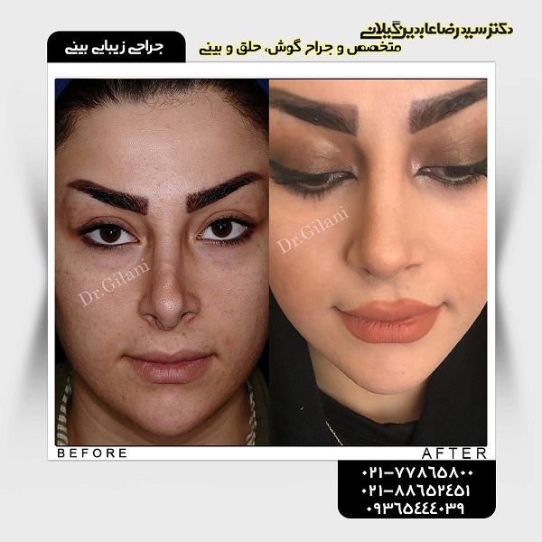 جراحی زیبایی بینی؛ قیمت سال ۹۸ و جدیدترین انواع آن