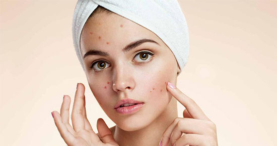چگونه از شر انواع جوش و آکنه خلاص شویم؟ چگونه از شر انواع جوش و آکنه خلاص شویم؟