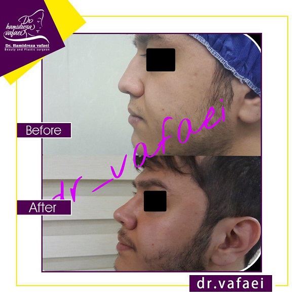 جراحی زیبایی بینی بدون درد و کبودی