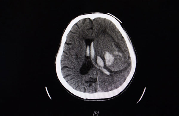 آنوریسم مغزی، علتها، علائم و درمان آنوریسم مغزی، علتها، علائم و درمان