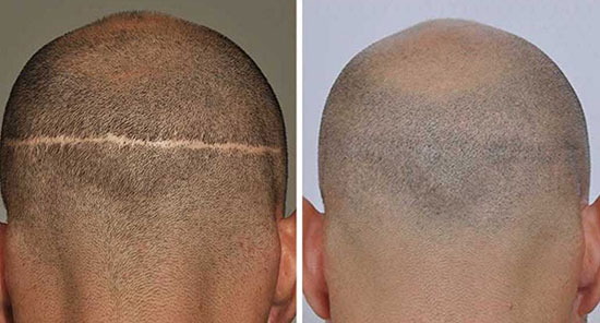 روشهای نوین کاشت مو