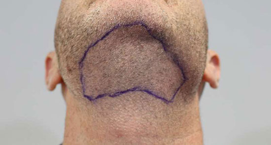 روشهای نوین کاشت مو