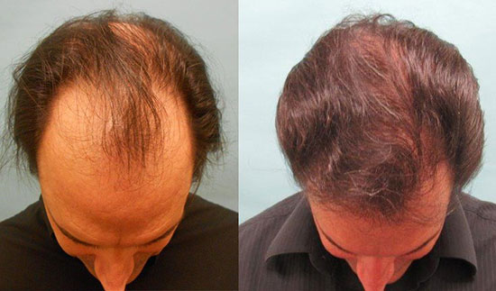 روشهای نوین کاشت مو