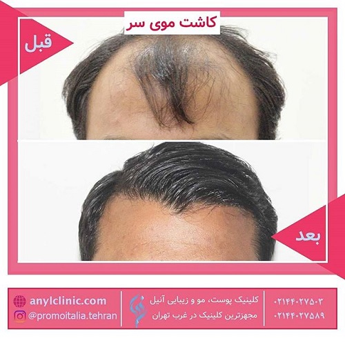 روشهای نوین کاشت مو