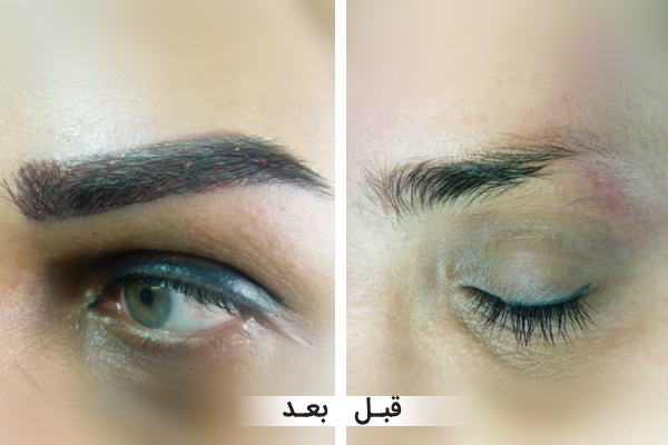 روشهای نوین کاشت مو