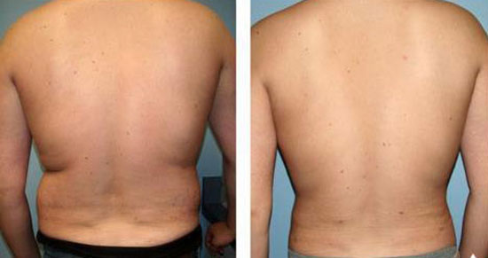 لیپوماتیک یا پیکرتراشی؛ مزایا و عوارض و هزینه + فیلم لیپوماتیک یا پیکرتراشی؛ مزایا و عوارض و هزینه + فیلم