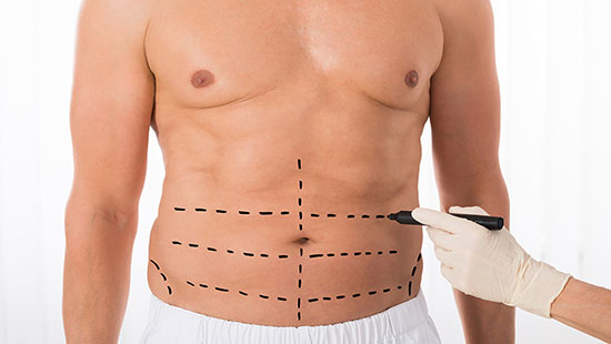 لیپوماتیک یا پیکرتراشی؛ مزایا و عوارض و هزینه + فیلم لیپوماتیک یا پیکرتراشی؛ مزایا و عوارض و هزینه + فیلم