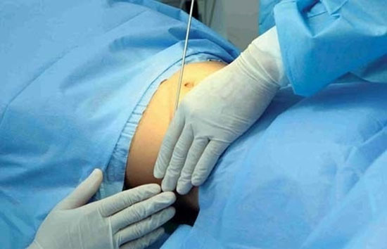 لیپوماتیک یا پیکرتراشی؛ مزایا و عوارض و هزینه + فیلم لیپوماتیک یا پیکرتراشی؛ مزایا و عوارض و هزینه + فیلم