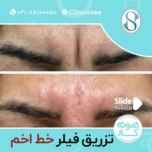 روش‌های لیفت و جوانسازی صورت؛ بدون جراحی و بدون دستگاه