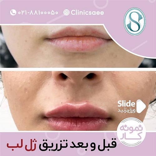 روش‌های لیفت و جوانسازی صورت؛ بدون جراحی و بدون دستگاه