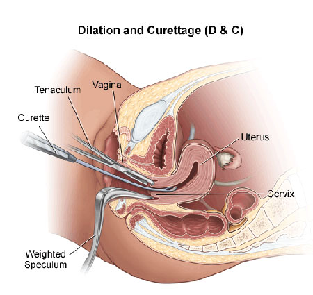 عوارض و مراقبت های بعد از کورتاژ عوارض و مراقبت های بعد از کورتاژ