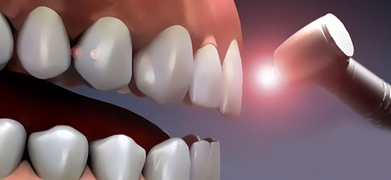 پیشگیری از بیماریها با لیزر پیشگیری از بیماریها با لیزر