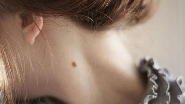 داشتن خال در نقاط مختلف بدن به چه معناست؟