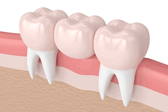 همه چیز درباره بریج دندان