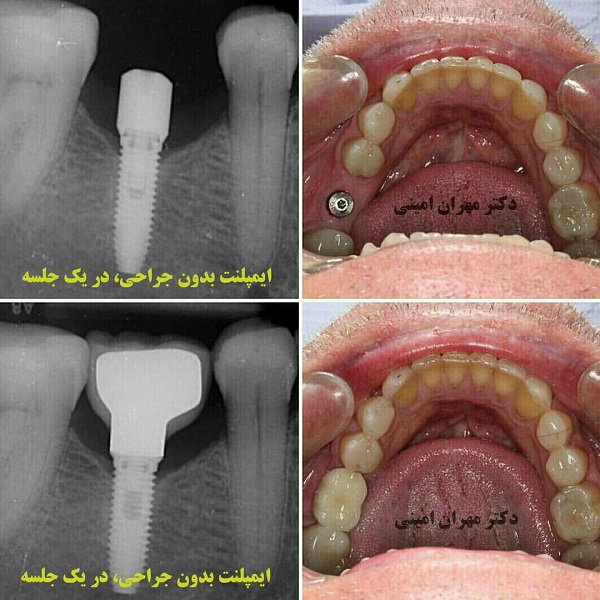 ایمپلنت به روش کاملا دیجیتال بدون برش و جراحی